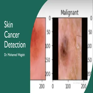 A seminar by Department of Computer Science and Information on "Skin cancer Detection"